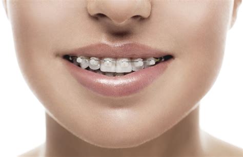 metal brackets teeth|most affordable braces near me.